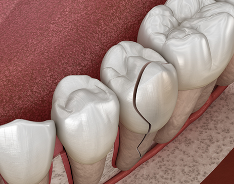 Illustration of a badly cracked tooth in the lower arch