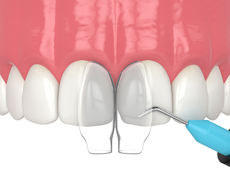 Illustration of dental bonding being performed on upper teeth