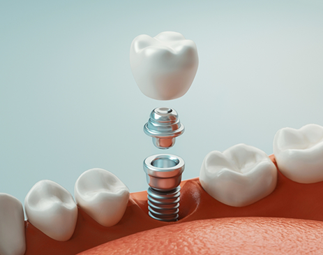 Illustration of dental implant, abutment, and crown being placed in lower arch