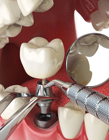 Illustration of a dental crown being attached to a dental implant