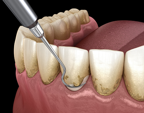 Illustration of gum disease treatment in Fort Smith in form of scaling and root planing