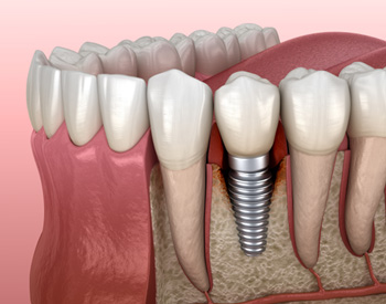 Illustration of single dental implant
