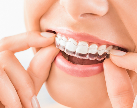 Woman placing clear aligner on upper teeth