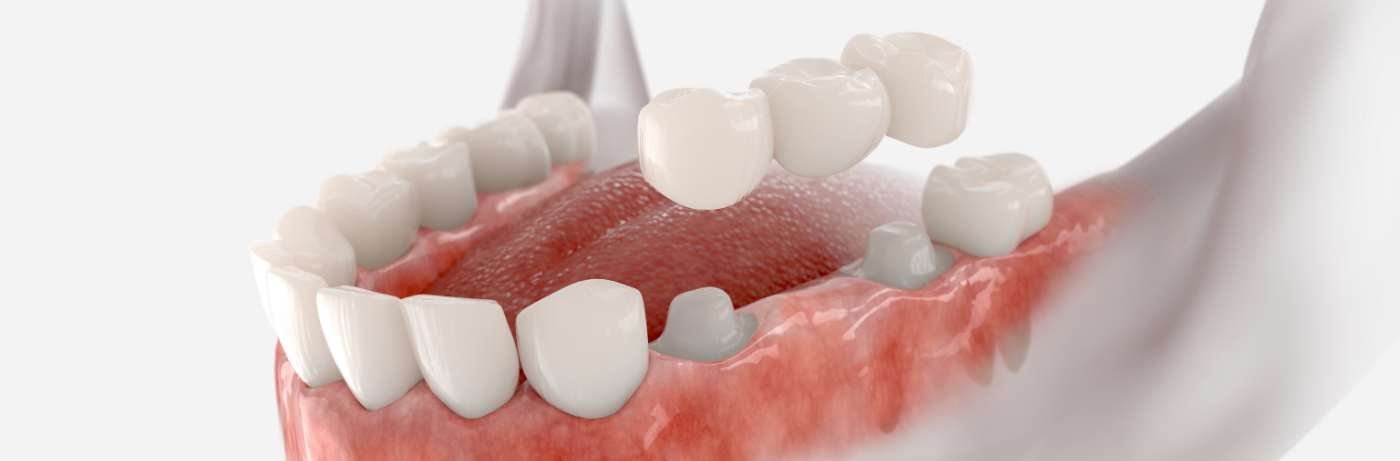 Illustration of dental bridge being used to replace missing teeth in Fort Smith