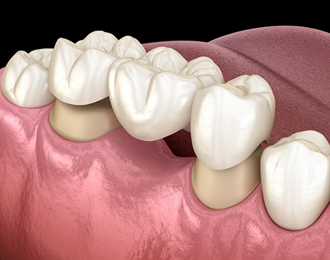 Illustration of dental crowns being placed on abutment teeth