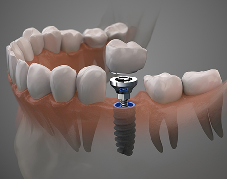 Illustration of crown and abutment being attached to dental implants