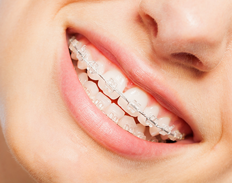 Close-up of woman smiling with clear Fastbraces