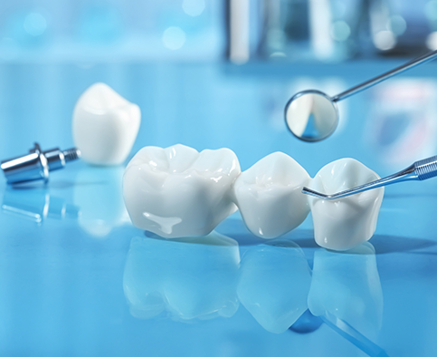 Dental bridge and dental implant on blue surface