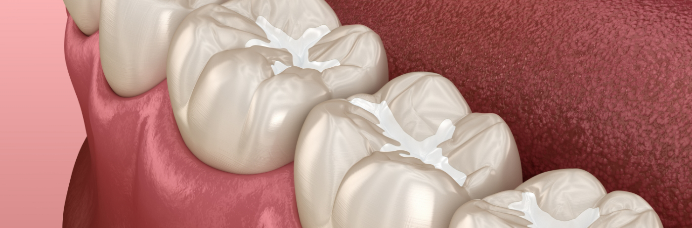 Illustration of teeth repaired with tooth-colored fillings