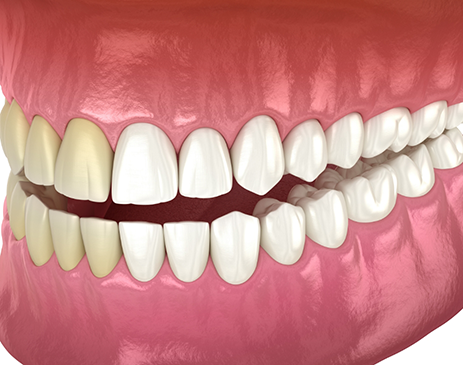 Model of teeth with half discolored and half white