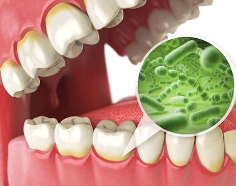 Illustration of teeth with hidden bacteria highlighted