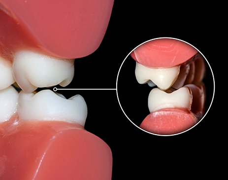 Close-up of teeth showing how they grind together