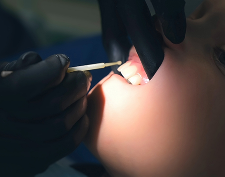 Close-up of patient receiving fluoride treatment