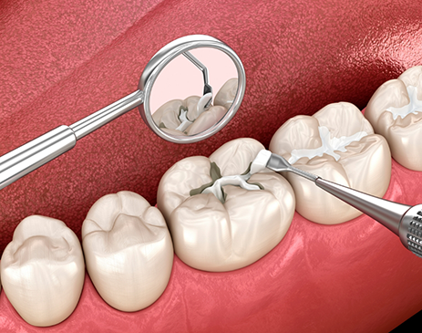 Illustration of tooth-colored filling being applied to teeth