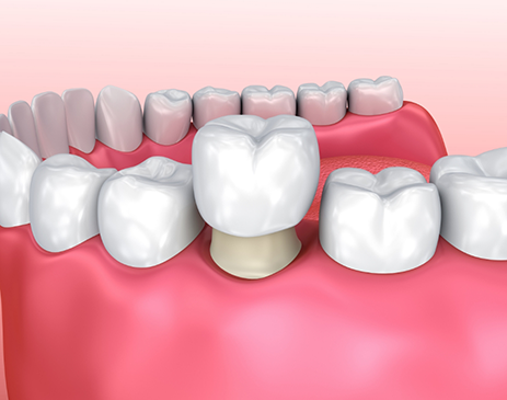 Illustration of dental crown being attached to prepared tooth