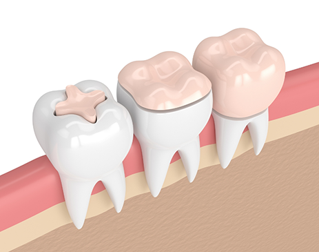 Illustration of multiple teeth with different restorations