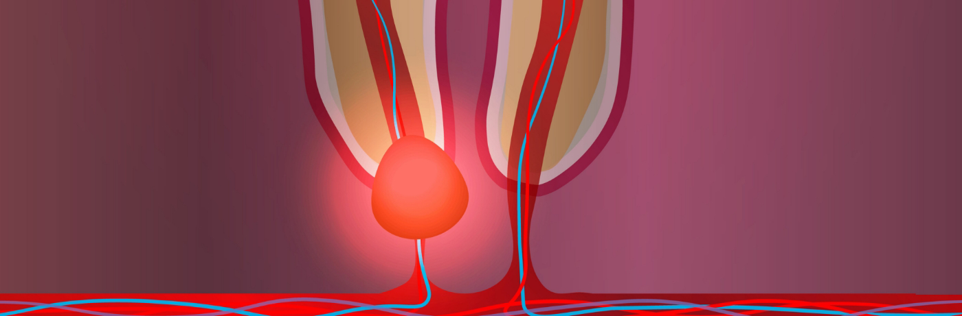 Illustration of tooth needing root canal treatment in Fort Smith