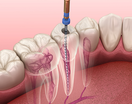 Illustration of tooth in lower arch receiving root canal treatment