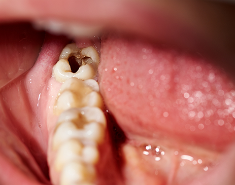 Close-up of badly decayed tooth near back of mouth