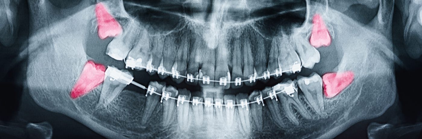 X-ray showing impacted wisdom teeth highlighted