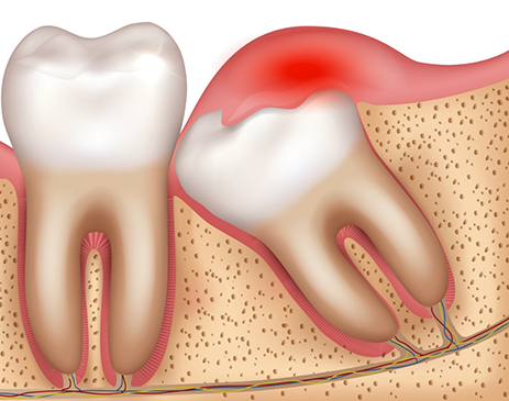 Illustration of impacted wisdom tooth in need of wisdom tooth extraction in Fort Smith