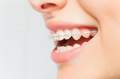 a beautiful smile with braces at Harper Dental in Fort Smith, AR