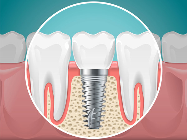 Diagram of a tooth replaced with a dental implant from Harper Dental in Fort Smith, AR