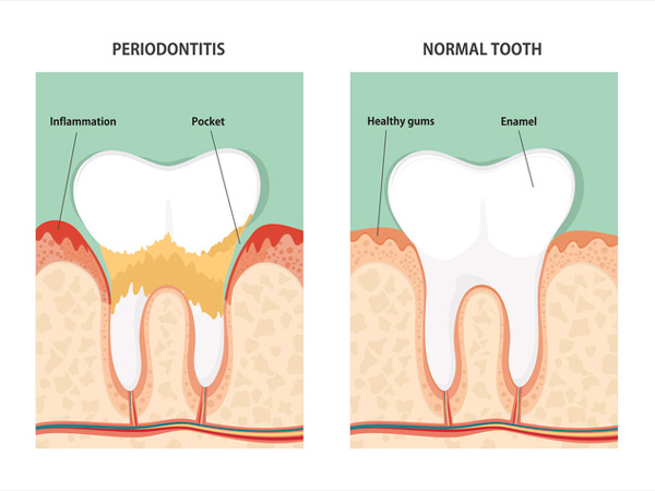 Diagram of periodontitis and health tooth.