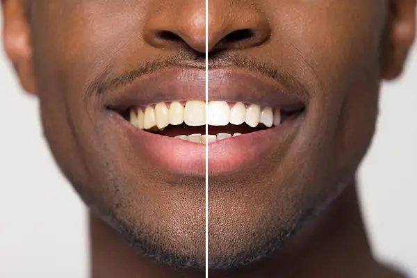 Close up comparison of before and after teeth whitening treatment on a man's smile at Harper Dental in Fort Smith, AR