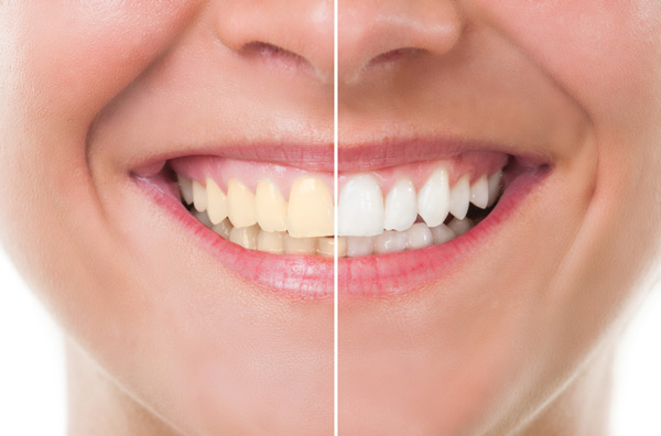 Before and after photo of teeth whitening treatment.