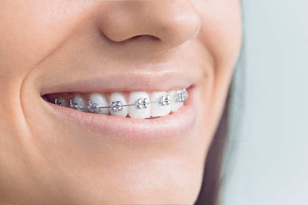 Close up of smiling woman with metal braces